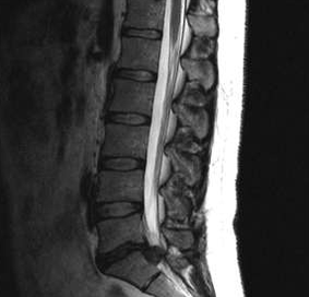 Opcións de diagnóstico para a osteocondrose lumbar