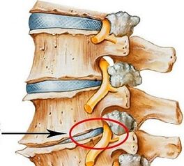 Por que é a osteocondrose lumbar