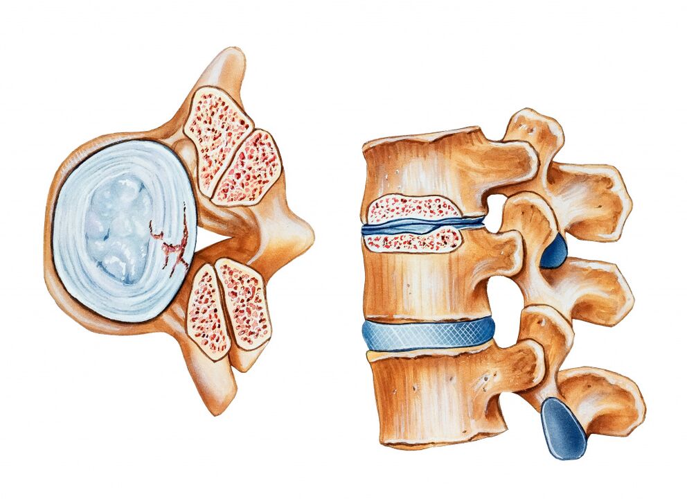 A osteocondrose da rexión cervical leva á destrución dos discos intervertebrais