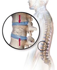 A osteoporose provoca dor nas costas na parte inferior das costas